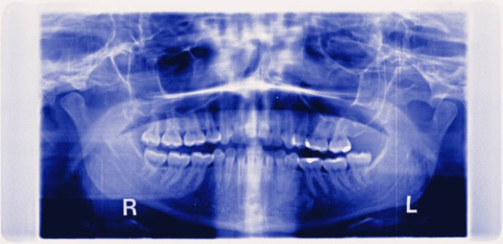 Partial Temporomandibular Joint Replacement by OrangeCountySurgeons.org  (2)